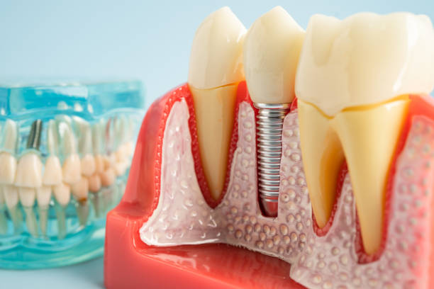 Dental Inlays and Onlays in Danvers, IL